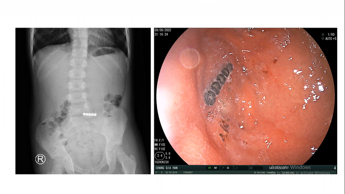 Trẻ nuốt 5 viên bi nam châm được cấp cứu kịp thời Ảnh 1