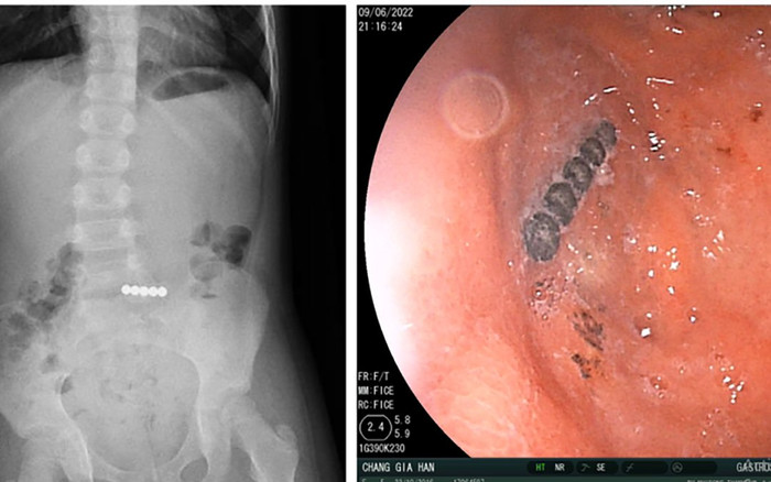 Trẻ nuốt 5 viên bi nam châm được cấp cứu kịp thời Ảnh 2