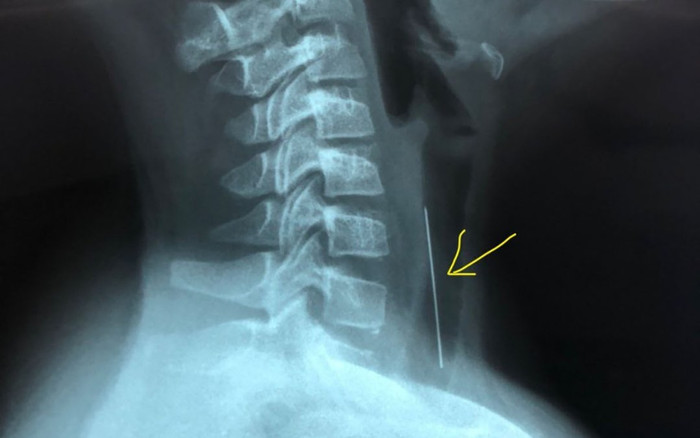 Bé trai 10 tuổi nuốt phải cây kim dài, nhập viện cấp cứu khẩn cấp Ảnh 2