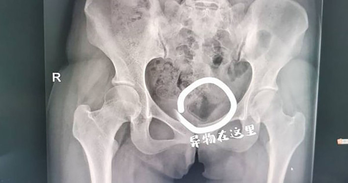 Tìm cảm giác lạ lúc 'mây mưa', thanh niên khiến bạn gái phải nhập viện vì dị vật lạ Ảnh 1