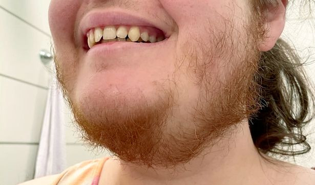 Cô gái vật lộn với bộ râu quai nón suốt 15 năm và quyết định 'thay đổi cuộc đời' Ảnh 2