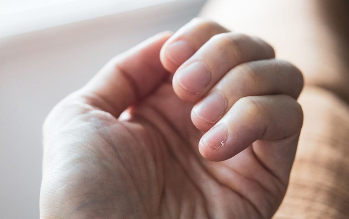 Móng tay trắng hoặc nhợt nhạt có thể là dấu hiệu của bệnh gì? Ảnh 2