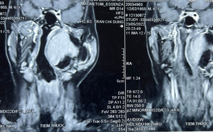 U khoảng bên họng phức tạp, hiếm gặp được phẫu thuật thành công Ảnh 2