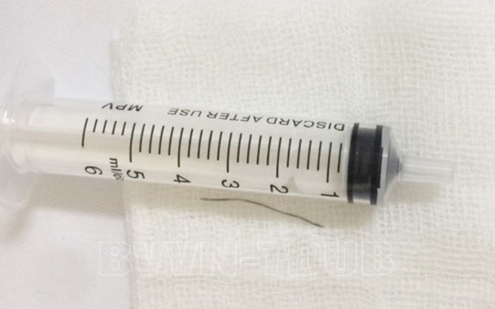 Suốt nửa năm ăn cơm thấy đau cổ họng, cụ bà 77 tuổi được lấy ra mảnh dây thép dài gần 4cm tại bệnh viện Ảnh 2
