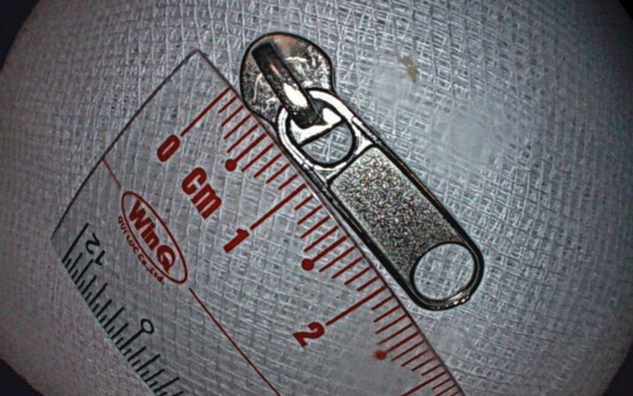 Bé trai 6 tuổi nuốt đầu kéo khóa vào dạ dày phải nhập viện khẩn cấp Ảnh 2