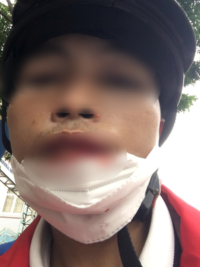 Sự việc khiến anh N. bị rách môi trong, phải khẩu 4 mũi.