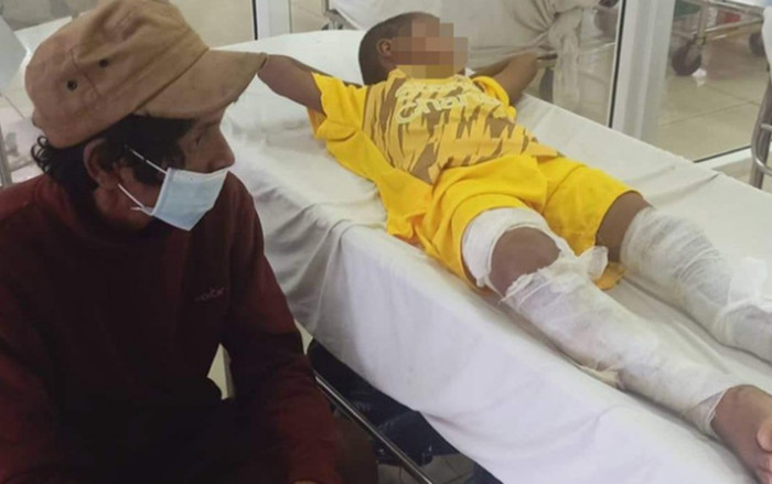 Thông tin cụ thể vụ bé trai 8 tuổi ở Đắk Lắk bị đốt bỏng chân Ảnh 2