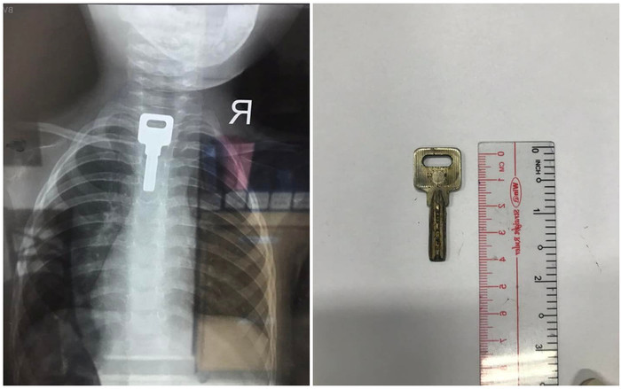 Đang chơi với chìa khóa, bé trai 2 tuổi bất ngờ nuốt luôn vào thực quản, nhập viện khẩn Ảnh 2