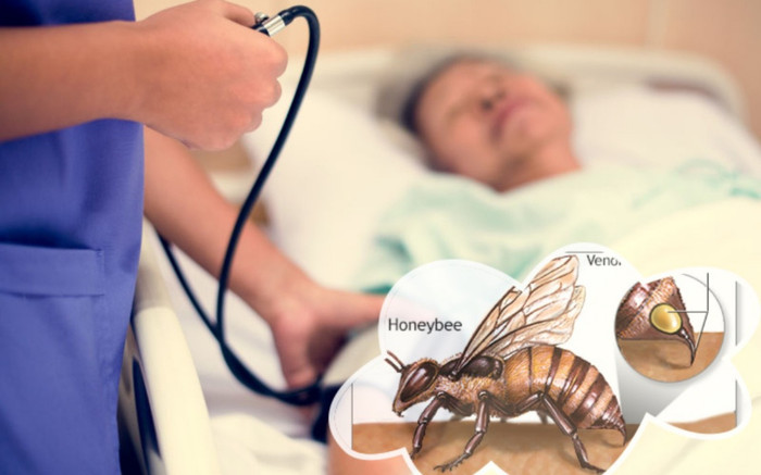 Sau khi bị ong đốt, người phụ nữ bất ngờ bị đột quỵ, nhập viện khẩn Ảnh 2