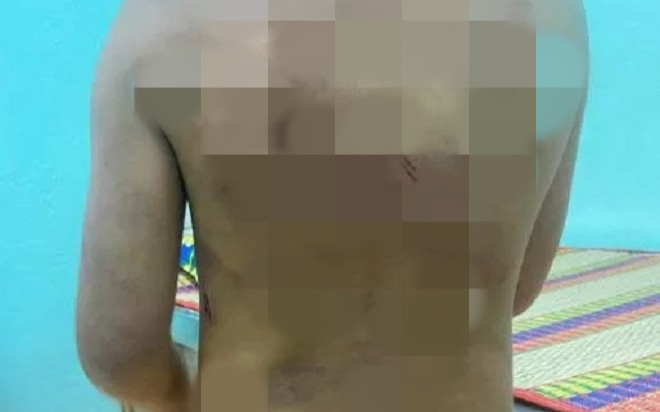 Từ Nghệ An vào Bình Phước ở cùng mẹ và cha dượng, bé gái được phát hiện cơ thể có nhiều vết bầm tím Ảnh 2