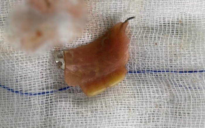 Bệnh nhân 37 tuổi bị hàm răng giả cắm ngang thực quản, nhập viện khẩn Ảnh 2