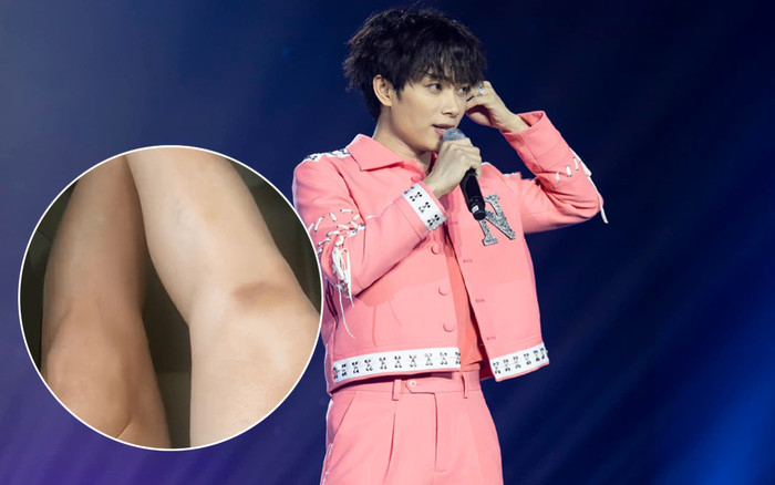 Xót xa những vết bầm tím trên chân Trúc Nhân sau mỗi buổi biểu diễn: Hóa ra đây chính là nguyên nhân? Ảnh 2