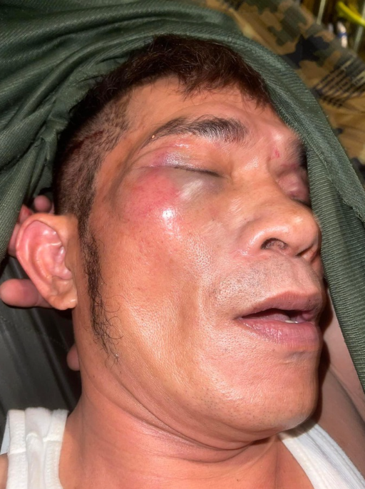 Ca sĩ Chế Phi bị đánh thương tích. (Ảnh: Người Lao Động)