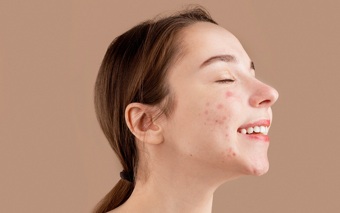 Bác sĩ da liễu mách nàng bí quyết xử lý sẹo mụn 'một lần và mãi mãi' Ảnh 2