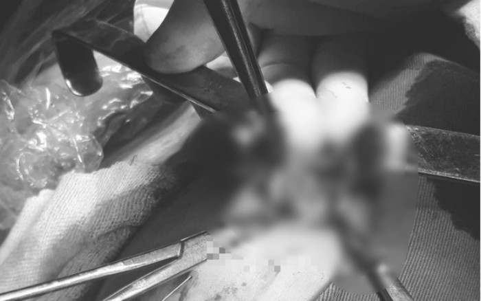 Nữ bệnh nhân 21 tuổi được phát hiện 3 khối u xơ vú Ảnh 2