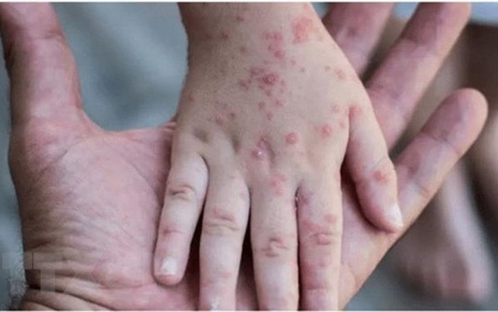 Thế giới có 44.503 ca đậu mùa khỉ, Bộ Y tế hướng dẫn cách phòng ngừa lây nhiễm Ảnh 2