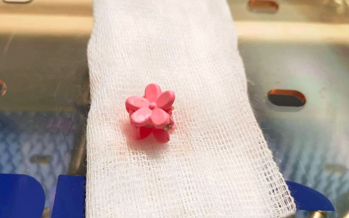 Bé gái bị viêm nhiễm vùng kín nặng vì kẹt kẹp tóc trong âm đạo suốt nửa năm Ảnh 2