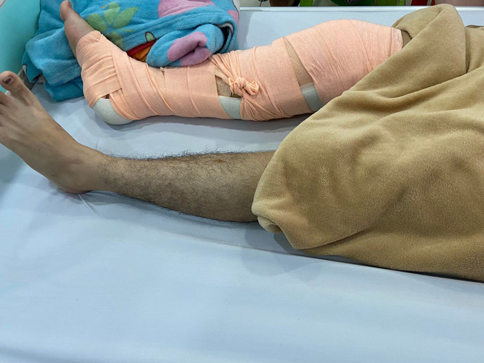 Sau khi nhảy từ tầng 2 xuống, chân Phúc bị gãy