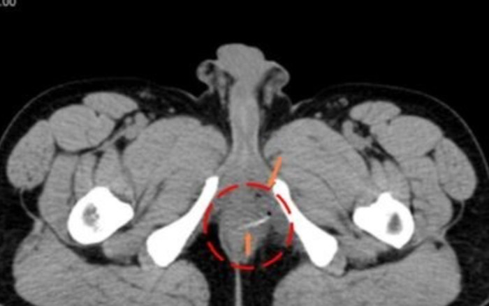 Người đàn ông phát hiện 'mắc xương cá tại trực tràng' khi đi tầm soát ung thư Ảnh 2