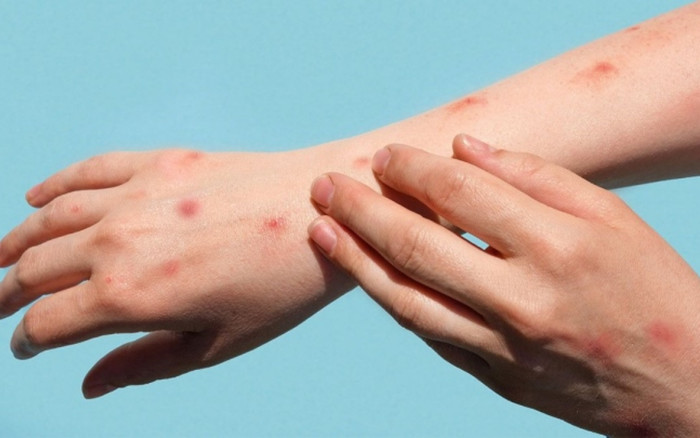 Sức khoẻ bệnh nhân mắc đậu mùa khỉ đầu tiên tại Việt Nam và những người tiếp xúc với ca bệnh hiện ra sao? Ảnh 2