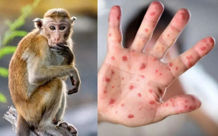 Khuyến cáo 6 biện pháp phòng chống bệnh đậu mùa khỉ mà ai cũng cần biết Ảnh 2