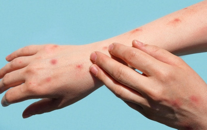 Bệnh đậu mùa khỉ có dễ lây nhiễm không? Ảnh 2