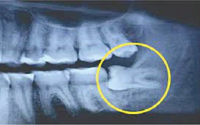 Nữ bệnh nhân tử vong sau khi nhổ 4 chiếc răng khôn cùng lúc Ảnh 2