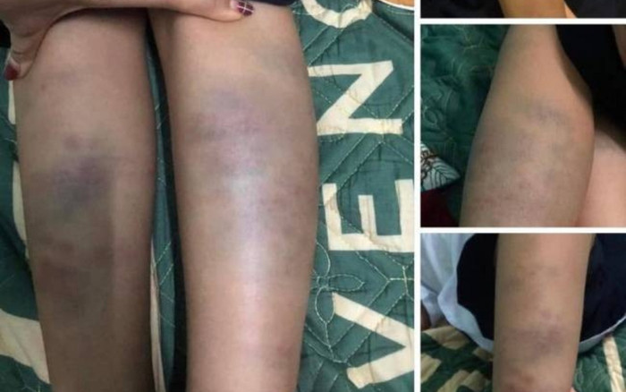 Xôn xao hình ảnh học sinh lớp 1 ở Đà Nẵng chân tay bầm tím sau buổi học Ảnh 2