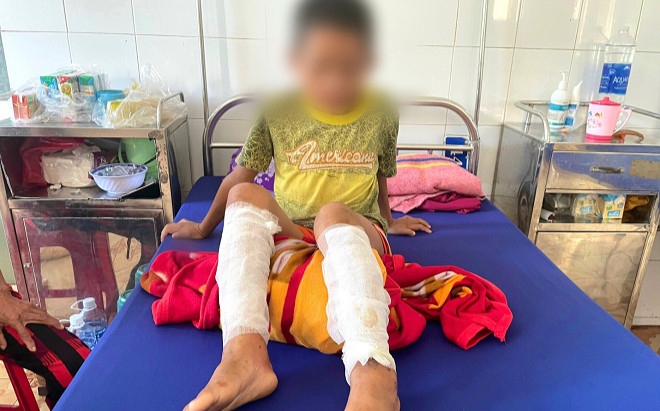 Xót xa đôi chân bỏng của đứa trẻ bị bố say rượu chất rơm đốt Ảnh 2