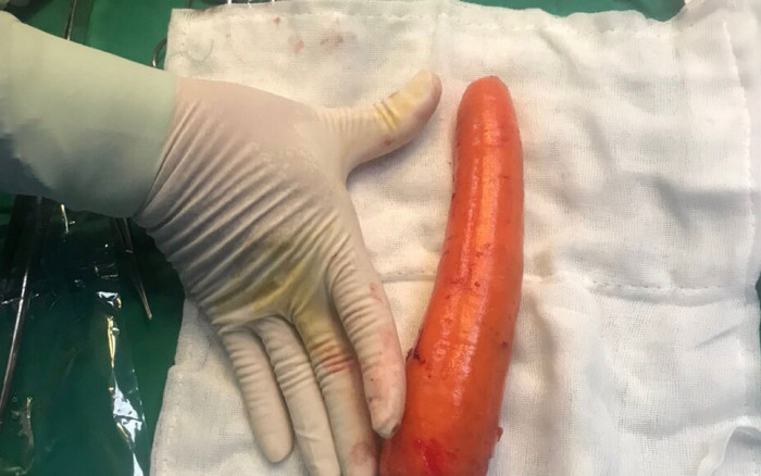 Thanh niên bị mắc kẹt củ cà rốt dài 20cm vì muốn thử 'cảm giác lạ' Ảnh 2