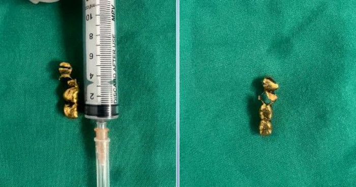 Dị vật được các bác sĩ lấy ra. (Ảnh: BV đa khoa tỉnh Phú Thọ).