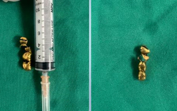 Đi làm răng, cụ ông 92 tuổi bị răng giả rơi vào phế quản Ảnh 2