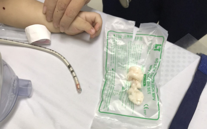 Bé 22 tháng tuổi ngưng tim, ngưng thở vì hóc loại dị vật mà cha mẹ thường cho con ăn Ảnh 2