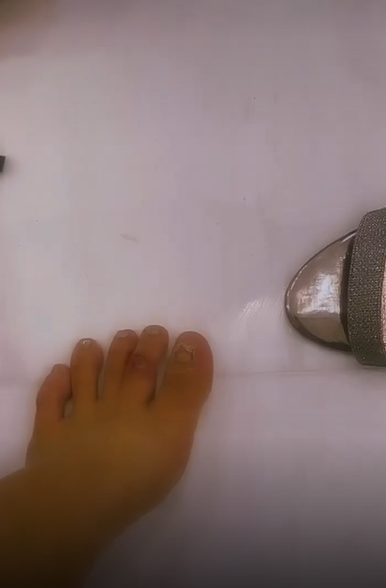 Dù quay mờ nhưng có thể thấy chân của người đẹp Cần Thơ đã bị sưng tím và mưng mủ do đi giày cao gót quá nhiều.