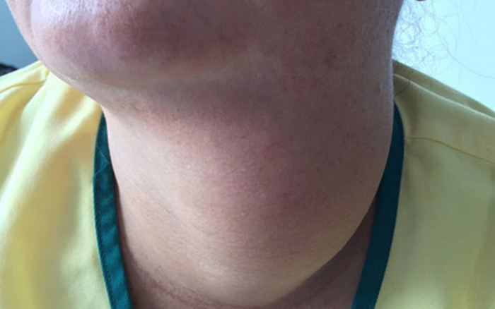 Nữ bệnh nhân được phẫu thuật bóc tách bướu cổ nặng gần 1kg Ảnh 2