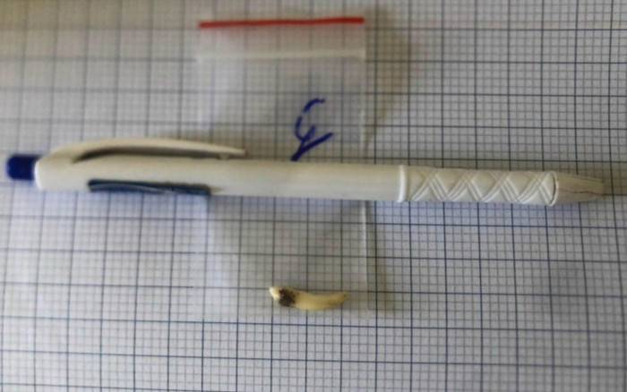 Cô gái trẻ đau đầu nhiều năm, đi khám phát hiện có 2 chiếc răng dài 2 cm mọc ngược trong hốc mũi Ảnh 2