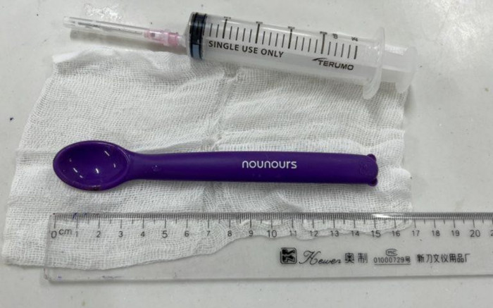 Cô gái say rượu rồi nuốt chiếc thìa nhựa dài 15cm vào bụng Ảnh 2