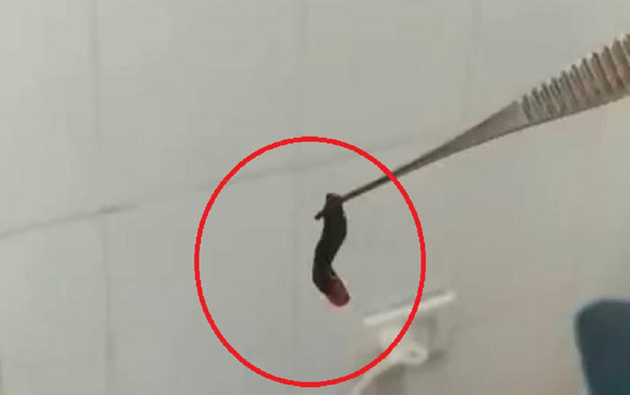 Đi khám vì thường xuyên chảy máu cam, tá hỏa phát hiện con vắt sống trong hốc mũi Ảnh 2