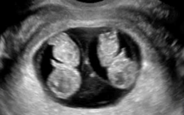 Vừa phát hiện song thai cùng trứng, khác giới tính hiếm gặp thứ 2 trên thế giới tại viện Phụ sản Hà Nội Ảnh 2