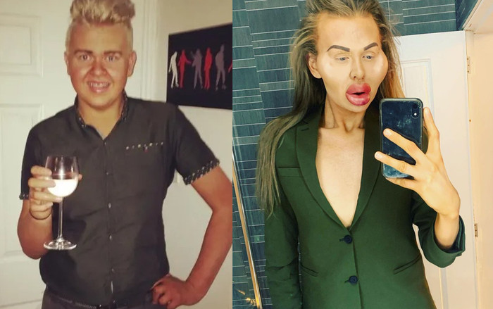 Người đàn ông nghiện tiêm filler đến mức 'mặt biến dạng' Ảnh 2