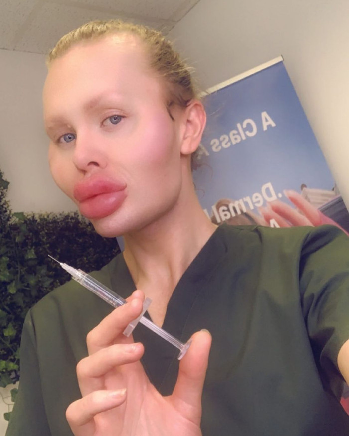 Alan tự học tiêm filler để thoả mãn đam mê. 