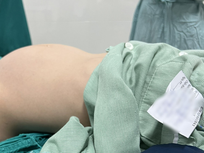 Khối u buồng trứng phát triển to trong ổ bụng của bé gái 12 tuổi. (Ảnh: BV Bãi Cháy).