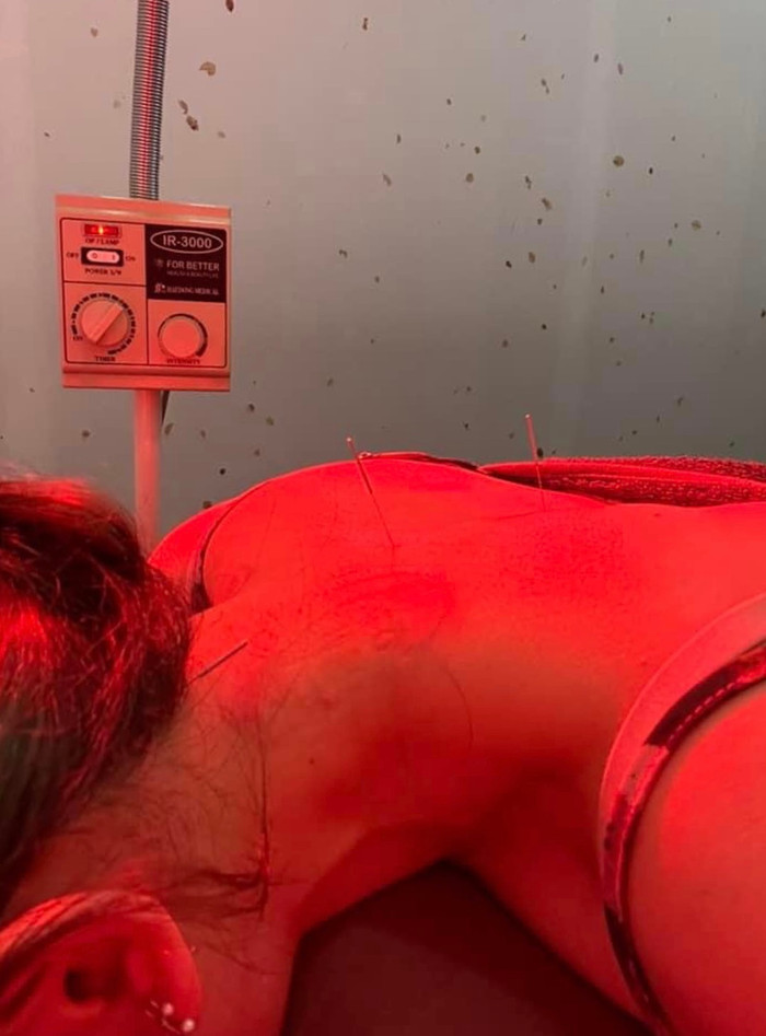 Sức khỏe của Hari Won đã được cải thiện nhiều nhưng chưa khỏi hoàn toàn nên nữ ca sĩ phải đi châm cứu mỗi ngày để giảm đau.