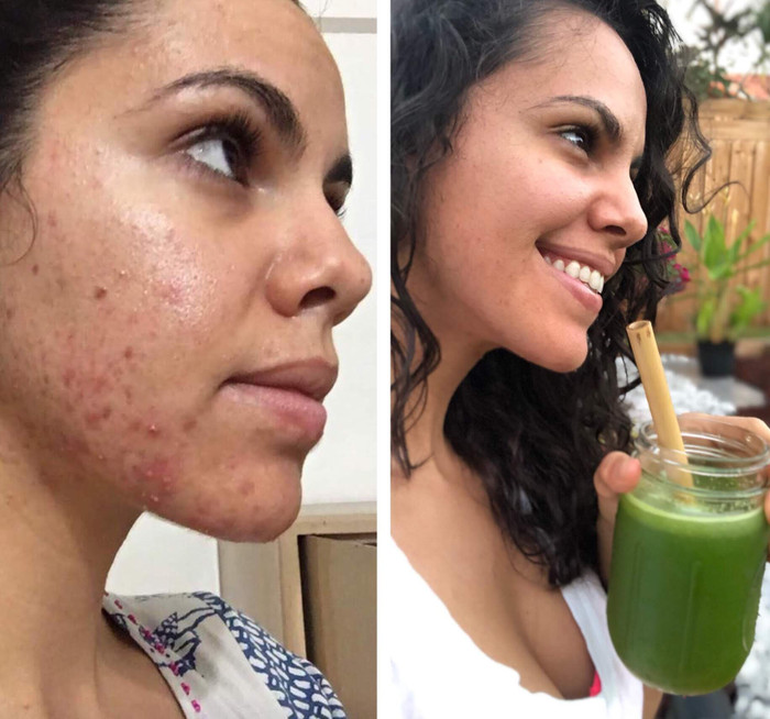 Nhờ khả năng thải độc tố mà nước ép cần tây hỗ trợ ngăn ngừa mụn rất hiệu quả, mang lại cho bạn làn da căng mịn, sang khoẻ. 