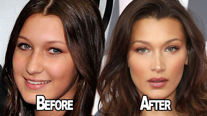  Bella Hadid từng hối hận vì 'dao kéo' Ảnh 1