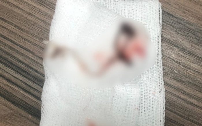 Hy hữu người phụ nữ ăn cá bị hóc lưỡi câu, nhập viện khẩn Ảnh 2