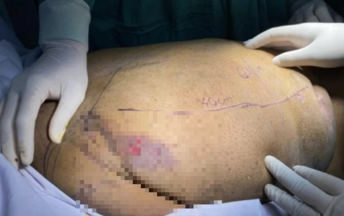 Người phụ nữ mắc căn bệnh hiếm khiến có hình dạng như mang mai rùa trên lưng Ảnh 2