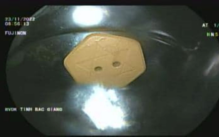 Cụ bà nhập viện khẩn vì ngậm đá để 'chữa bệnh' rồi vô tình nuốt luôn Ảnh 2