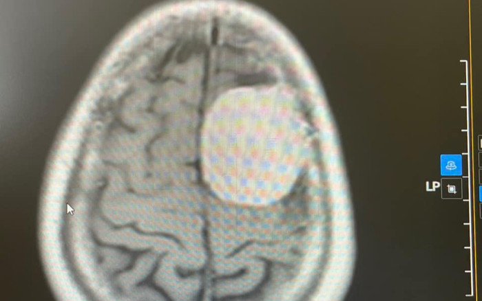 Sau cơn đau đầu dữ dội, người đàn ông được bác sĩ phát hiện thứ này gây sốc Ảnh 2