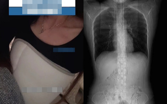 Cô gái gãy 4 xương sườn sau bữa ăn cay Ảnh 2